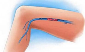 Mélyvénás trombózis